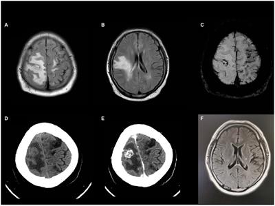 Intracranial infection caused by Mycobacterium rhodesiae with specific imaging findings and good response to medication: a case report and literature review